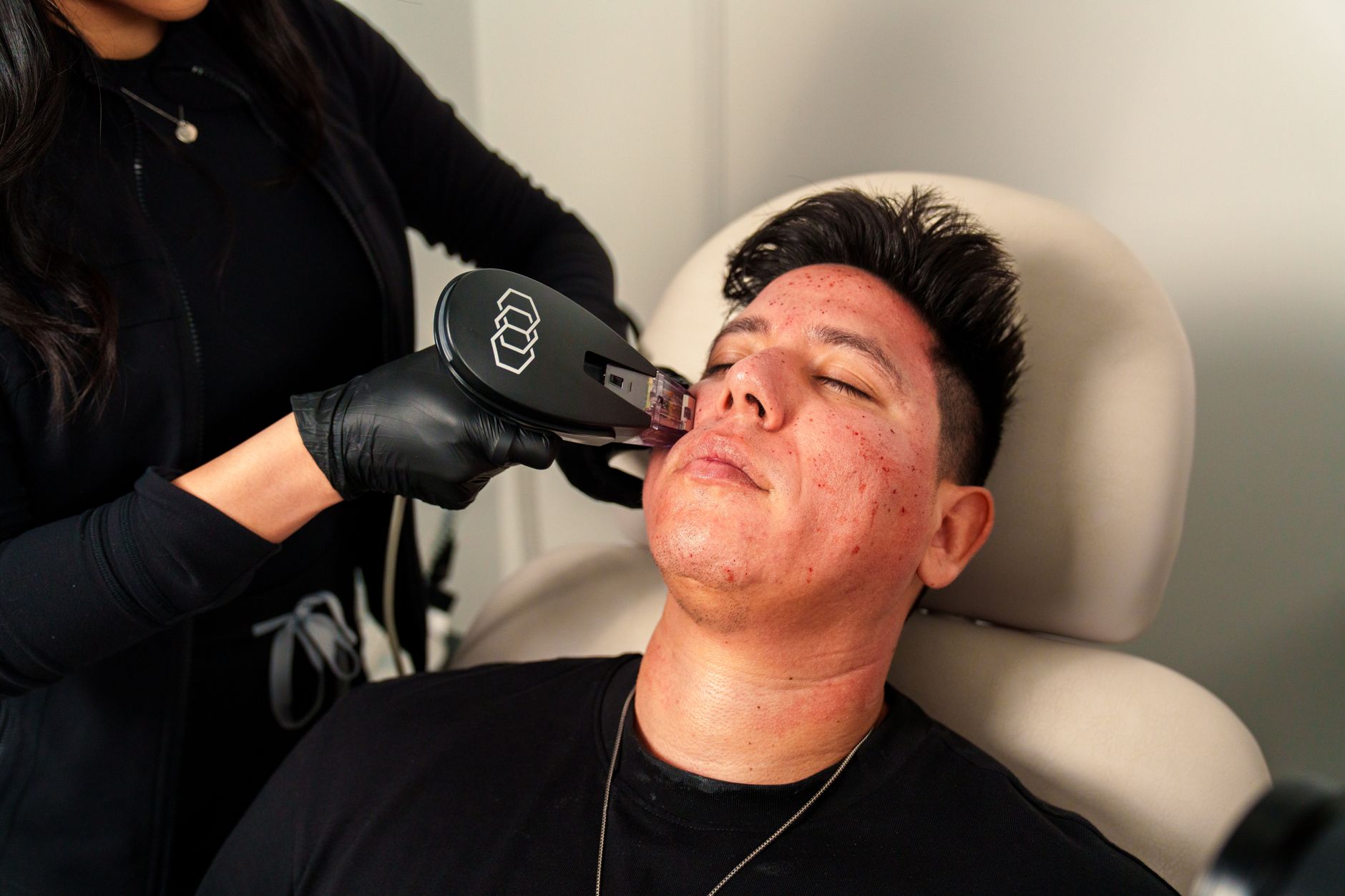 Local SEO in Santa Ana, CA near Downtown Santa Ana & Artists Village | OCWebPros. Man receives Morpheus8 facial treatment in 